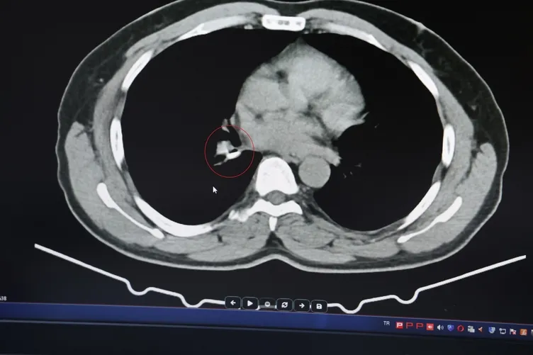 1.5 yıldır astım tedavisi görüyordu gerçek bambaşka çıktı: Uzun süre kendini belli etmeyebilir!