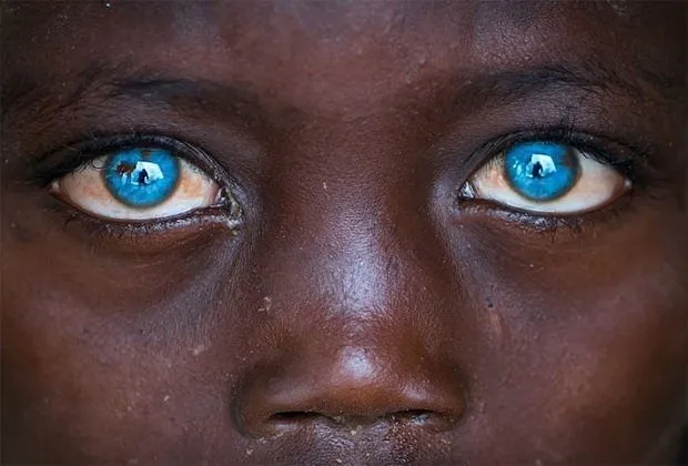 Deniz gözlü ’Afrikalı’ çocuk