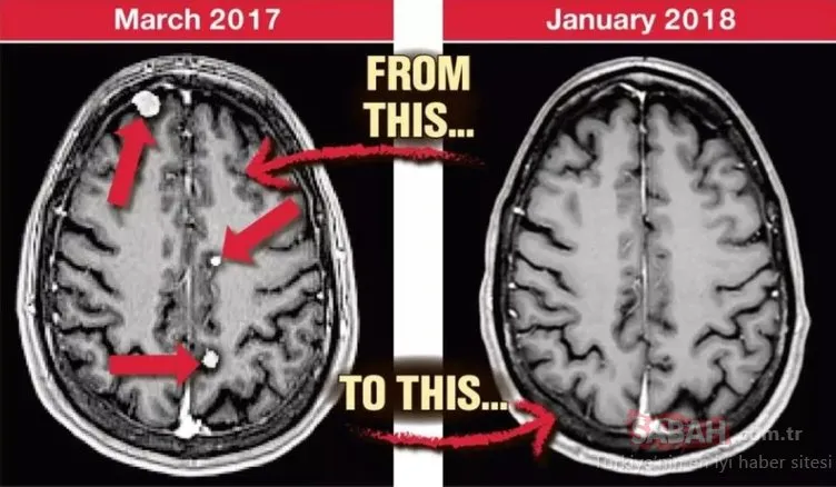 Beynindeki 25 tane tümörü kendi tedavi etti!