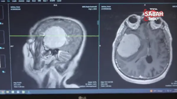 Beyin tümörlerinde zaman kaybı ölüme yol açıyor | Video