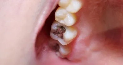 Çürük dişleri tedavi ettiği ortaya çıktı! İşte güçlü dişlerin püf noktası