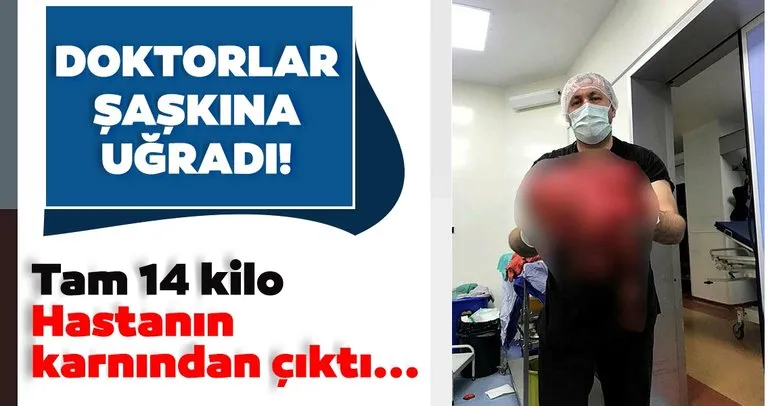 Son dakika haberi | Doktorlar şaşkına uğradı! Tam 14 kilo: Hastanın karnından çıktı...