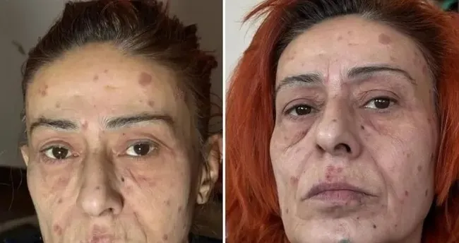 Saç boyası yüzünü yakmıştı! Şarkıcı Yıldız Tilbe son sağlık durumu hakkında bilgi verdi!