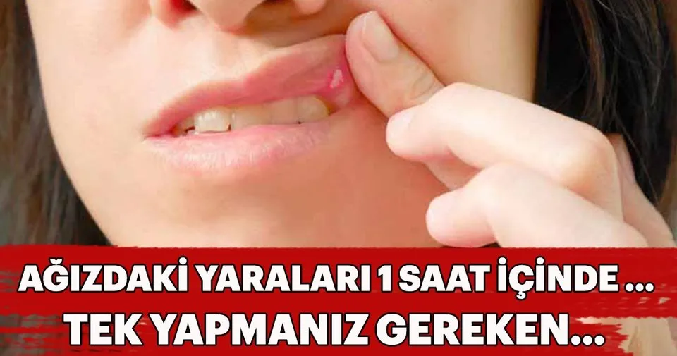 agiz yaralari ne iyi gelir agiz ici