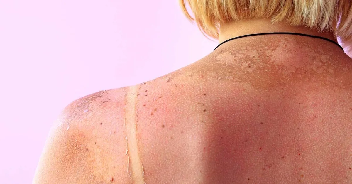 Gunes Lekesi Nasil Neyle Gecer Gunes Lekesi Tedavisi Krem Ile Nasil Yapilir Saglik Haberleri