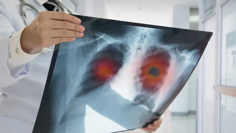 Bu belirtiler akciğer kanseri olabileceğinizi söylüyor! Eğer öksürüp...