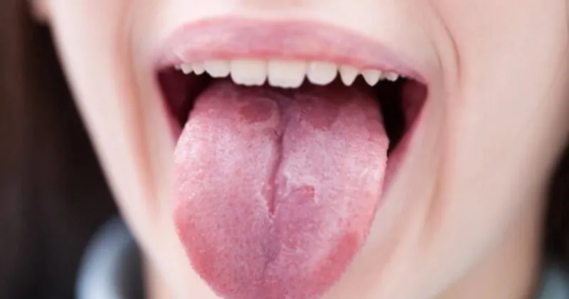 dil kanseri belirtileri nelerdir dil