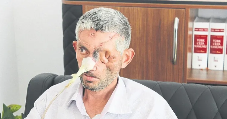 Gözünü kanserden kaybetmiş