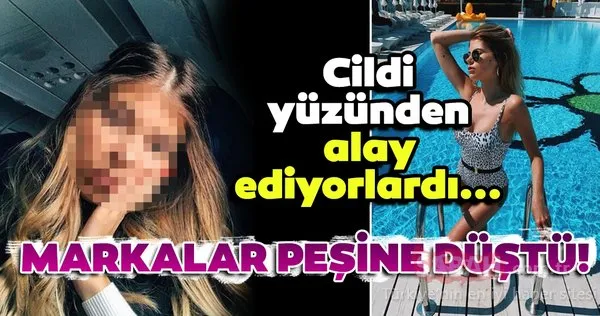 Cildi yüzünden herkes alay ediyordu... Şimdi dünya markaları peşinden koşuyor!