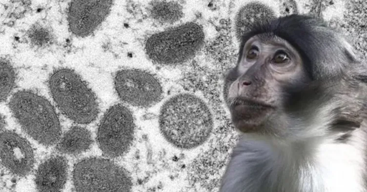 Maymun çiçeği virüsü belirtileri belirtileri nelerdir, nasıl bulaşır, tedavisi var mı? Türkiye’de de görülen maymun çiçeği belirtileri ve tedavisini uzmanlar açıkladı!