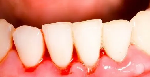 Diş kazasıyla karşı karşıya kalırsanız mutlaka bunu yapın!