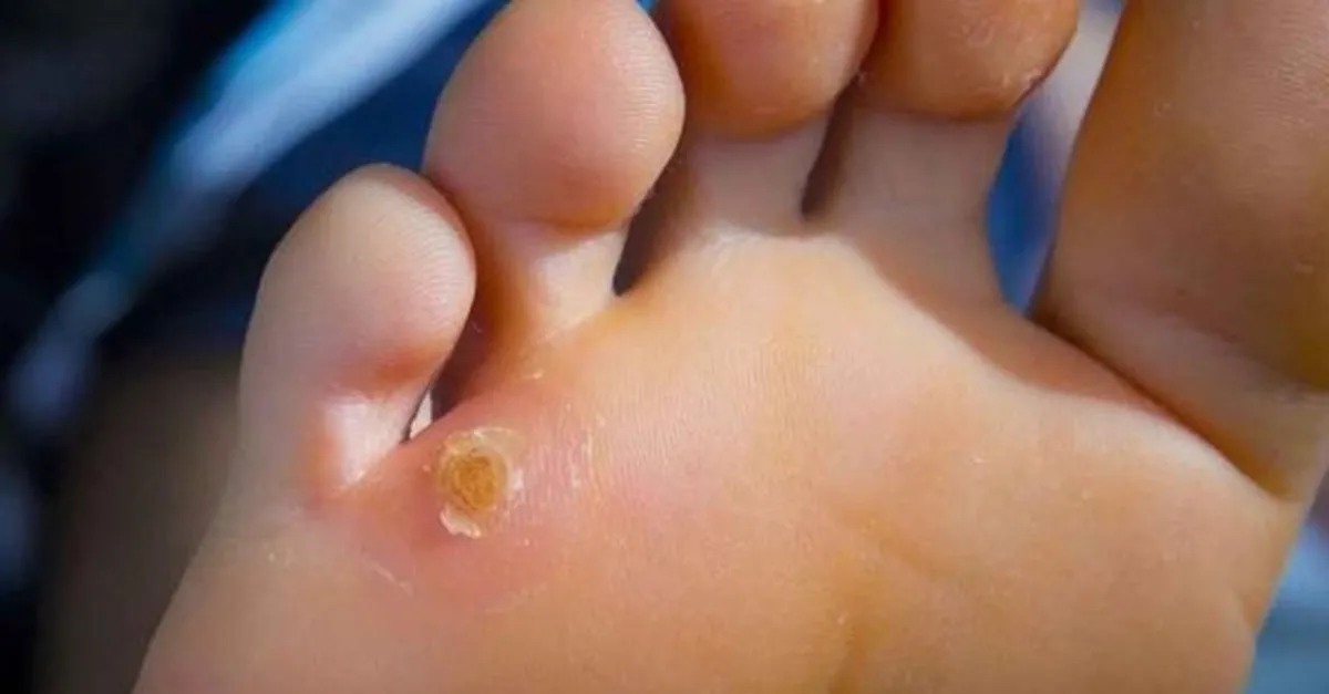 Ayakta Nasir Nasil Gecer Ayakta Nasir Neden Olur Saglik Haberleri