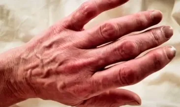 Birden Morarmaya Basladi Fark Ettiklerinde Artik Cok Gecti Sayfa 6 Kadin Haberleri Birden Morarmaya Basladi Fark Ettiklerinde Artik Cok Gecti Sayfa 6 Kadin Haberleri