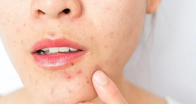 evde bitkisel sivilce kurutucu tarifler