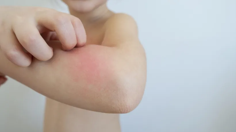 Egzaması olan çocuklar için altın değerinde bakım önerileri