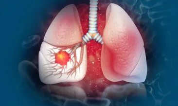 Akciğer kanserinde tarama yaşı düştü