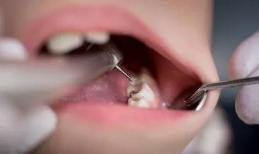 Diş çürükleri koronavirüse yakalanma riskini artırıyor