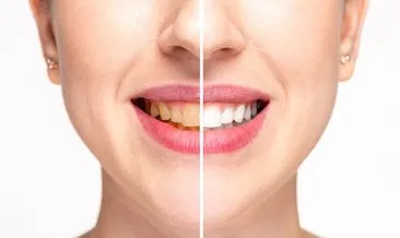 Diş beyazlatma sonrası renkli gıda tüketiminden kaçının