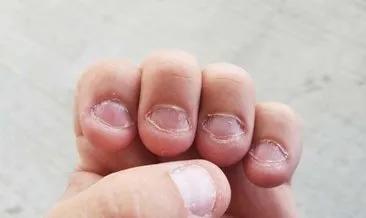 kesin cozum tirnak yeme en kolay nasil birakilir cocuk haberleri