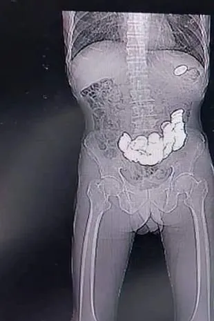 X-Ray cihazına bakan doktorlar şaştı kaldı! Midesinden tam 187 tane çıkarıldı