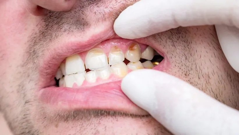 ‘Dişlerdeki şekil bozuklukları psikolojik problemlere neden olabiliyor’