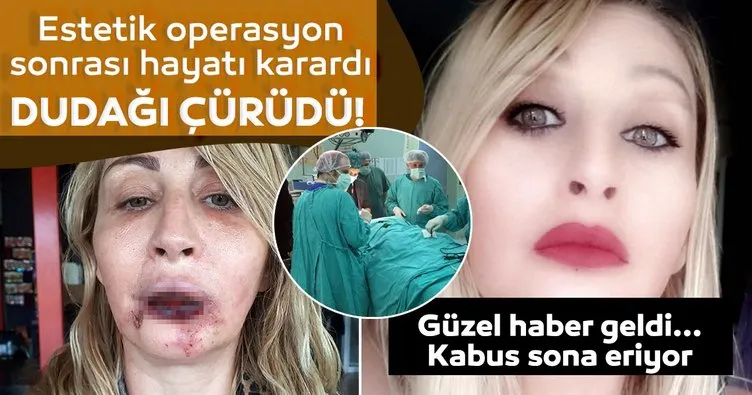 Estetik operasyon sonrası dudağı çürüyen Songül Uzunoğlu’ndan güzel haber geldi