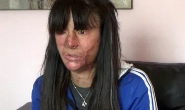 Yüzü asitli saldırı sonucu yanan Berfin Özek: Çektiğim acılar 1-2 yıla sığacak acılar değil