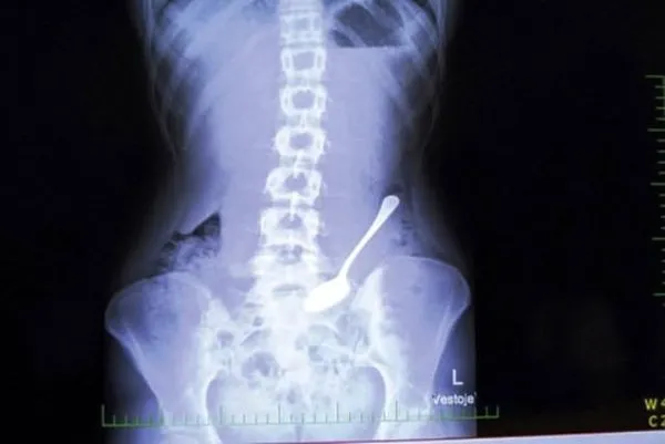 Midesinden çıkanlar doktorları şoke etti