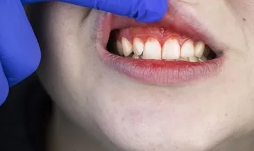 Diş eti çekilmesinin belirtisi! Dişinizi fırçalarken kan görüyorsanız...