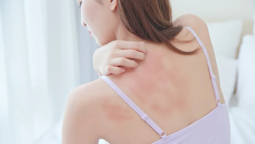 COVİD-19 KURDEŞENE NEDEN OLABİLİR