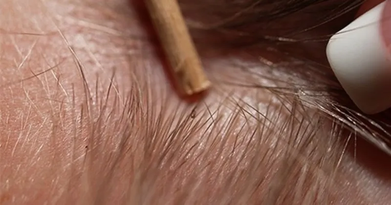 Bit Nedir Bitten Kurtulma Yollari Nelerdir Saglik Haberleri Bit Nedir Bitten Kurtulma Yollari Nelerdir Saglik Haberleri