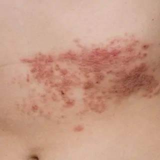 Zona hastalığı belirtileri nelerdir? Zona hastalığı kansere sebep olur mu?