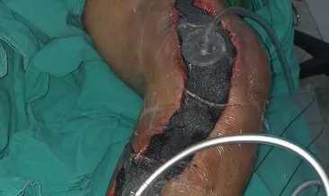 Bacağı kesilir dediler, ameliyatla kurtuldu #adiyaman