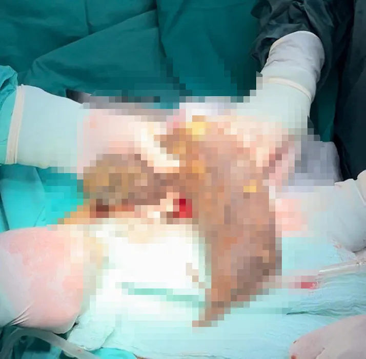 Doktorlar bile şaşkın: Midesinden 50 santim saç yumağı çıktı!