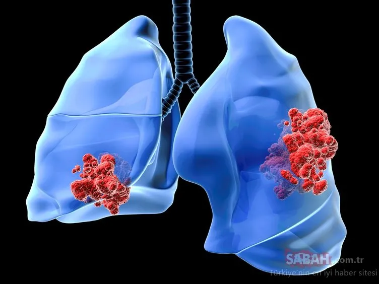 Akciğer kanseri nasıl oluşur? Akciğer kanseri belirtileri nelerdir?