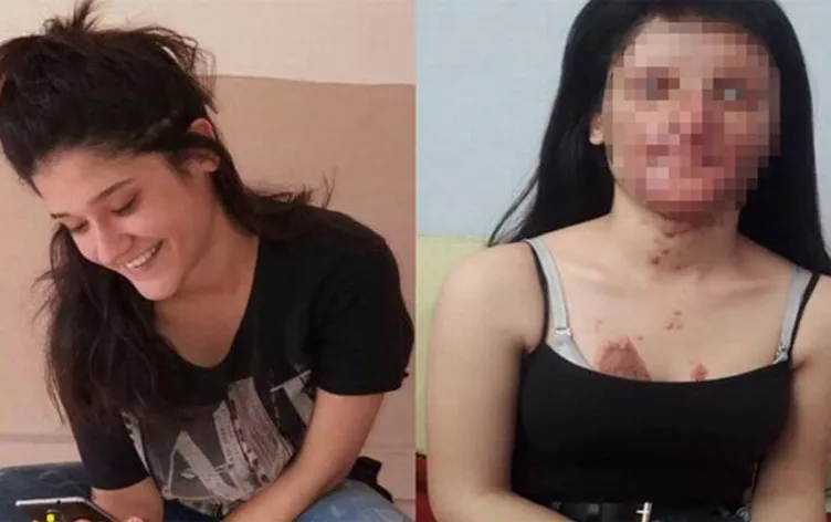 Yüzünü yakan kişiyle evlenen Berfin Özek herkesi şoke etti! Babası SABAH’a konuştu: Nasıl yapar bunu?