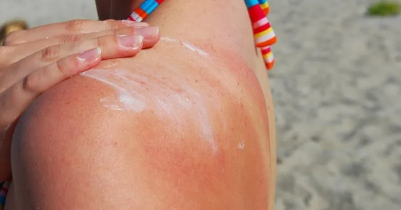 gunes yanigi nasil kac gunde gecer