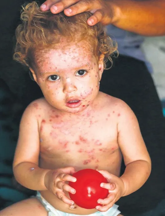 25 yıl sonra bir felaket daha! Gazze’de ölümcül çocuk felci kâbusu