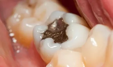 Dişinde dolgusu olanlar dikkat! Uzmanından uyarı geldi