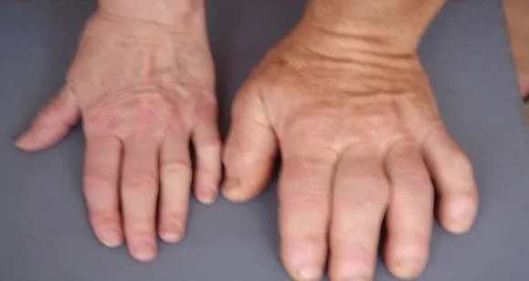 Dev Hastaligi Nedir Agromegali Nedir Dev Hastaligi Belirtileri Nelerdir Saglik Haberleri