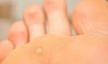 ayaktaki nasir nasil gecer nasir