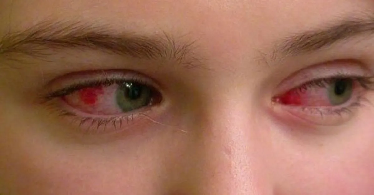 goz nezlesi belirtileri ve tedavi yontemleri goz nezlesi neden olur nasil gecer saglik haberleri