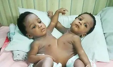 Nijerya’daki siyam ikizleri 78 doktor tarafından ayrıldı! Siyam ikizlerinin ameliyatı 12 saat sürdü!