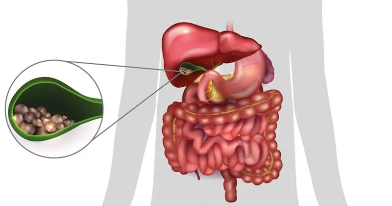 safra kesesi agrisi neden olur safra