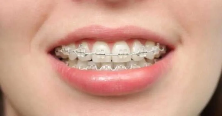 Rüyada Diş Teli Takmak Ne Anlama Gelir? Rüyada Diş Teli Takmanın Anlamı