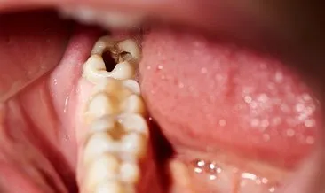Neden Dişlerimizi erken yaşta kaybediyoruz: Diş eti hastalıklarımızdan dolayı  genlerimizi mi suçlamalıyız?
