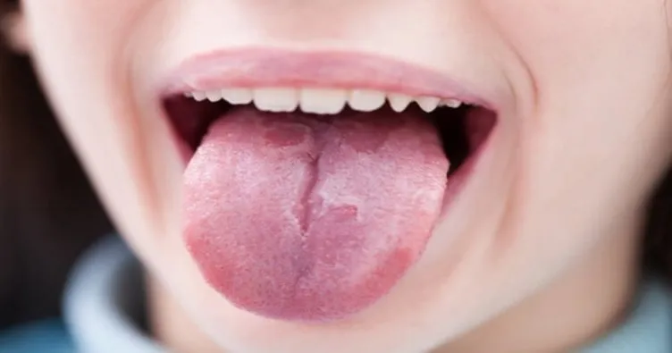 dil yarasina ne iyi gelir dilin uzerinde cikan yaralar neden olur ve nasil gecer saglik haberleri dil yarasina ne iyi gelir dilin uzerinde cikan yaralar neden olur ve nasil gecer saglik haberleri