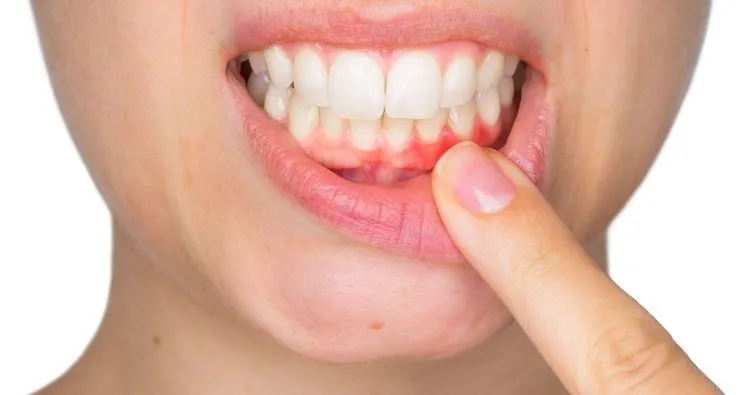 Diş Eti Şişmesine Ne İyi Gelir? Evde Doğal Ve Bitkisel Tedavi Yöntemleri İle Diş Eti Şişmesi Nasıl Geçer?