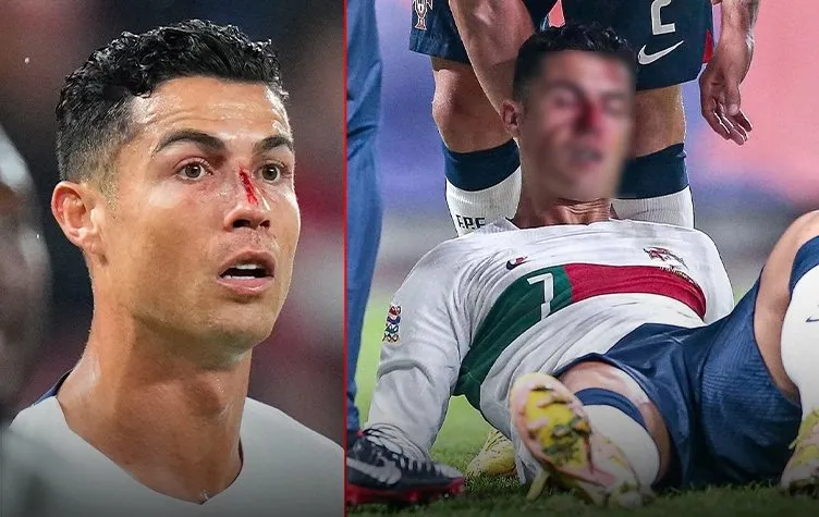 Çekya - Portekiz maçında Cristiano Ronaldo kanlar içinde kaldı! Futbolseverleri korkuttu...