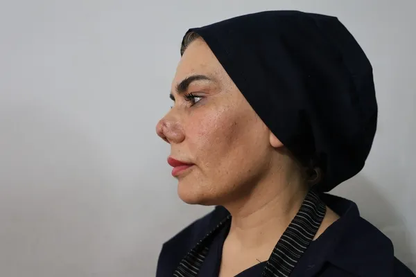 bakim-merkezinde-burnu-kirilinca-hayati-kabusa-dondu-4-yilda-tam-4-kez-bicak-altina-yatti-hem-yandi-hem-yirtil-1787137425733.jpg